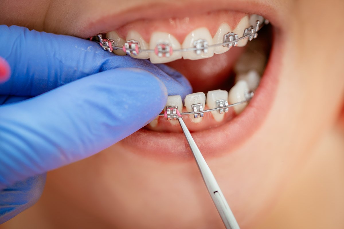 The-Orthodontic-Treatment-Process-A-Step-By-Step-Guide