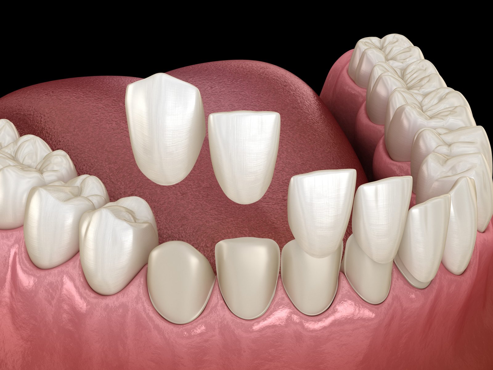 Dental veneer placement procedure