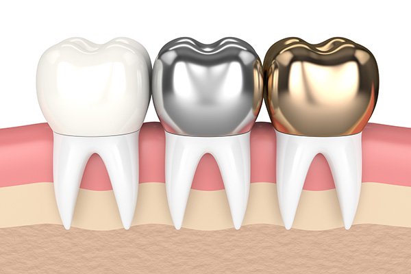 metal-crowns-vs-porcelain-dental-crowns