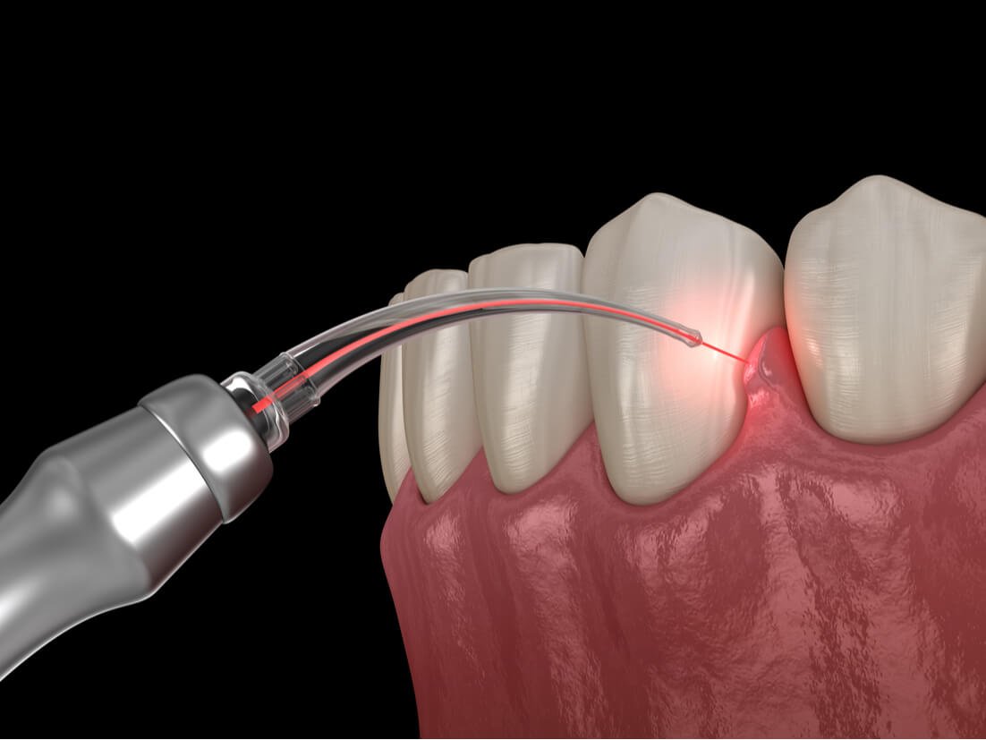 root_canal_treatment_laser_in_Houston_TX